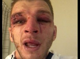 Лицо Дэна Хукера после боя с Порье